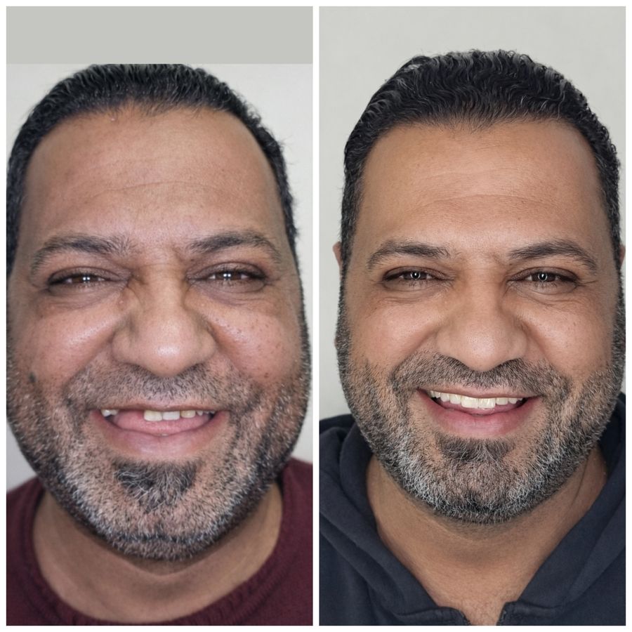 قبل وبعد - حالة 1